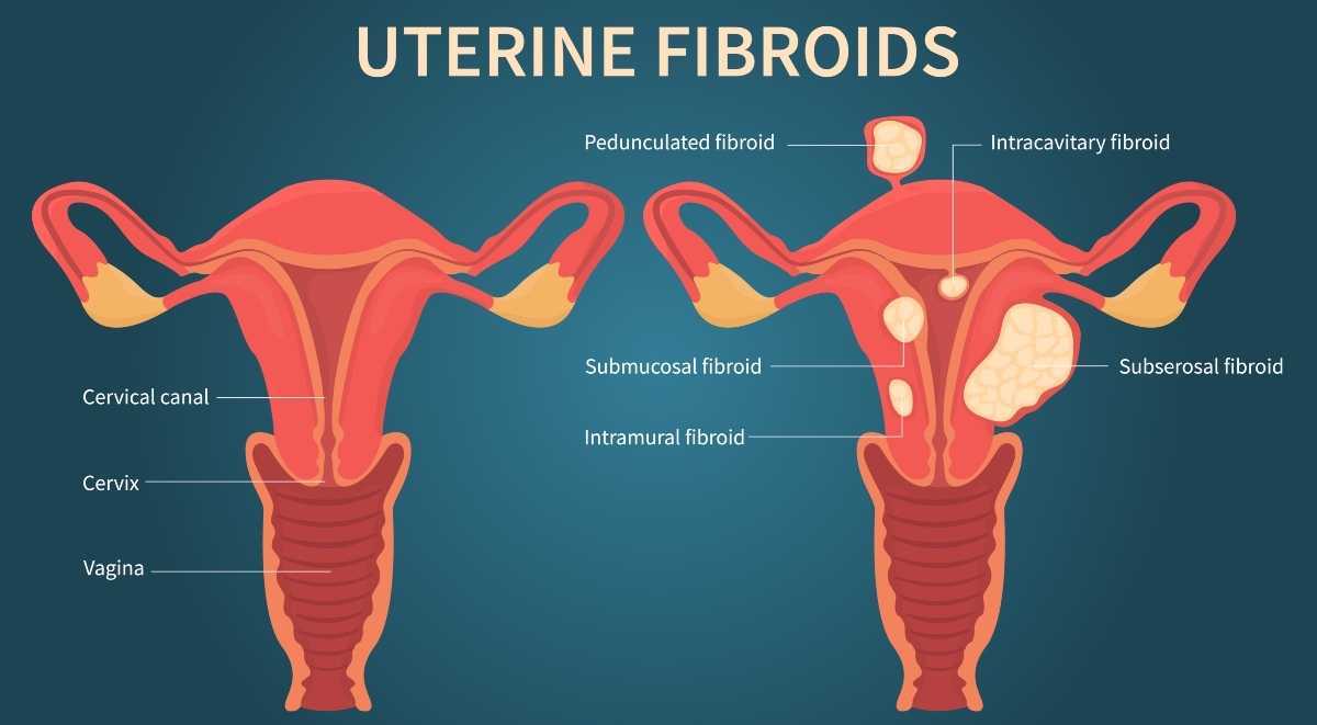 Miomas uterinos após a menopausa