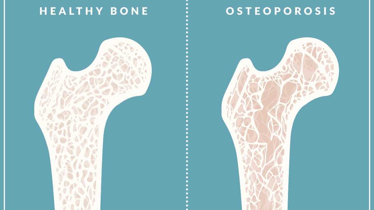 Uma ilustração da osteoporose, que pode ser tratada com medicamentos
