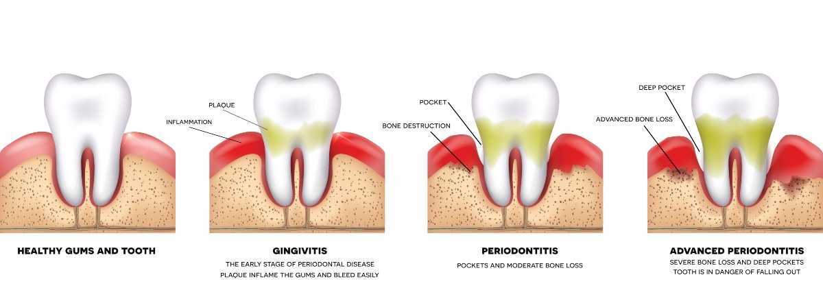 Uma ilustração de doença gengival ou gengivite e periodontite