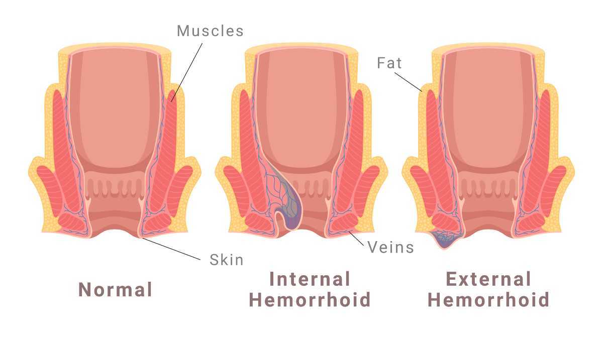 ilustracja przedstawiająca hemoroidy wewnętrzne i zewnętrzne, które powodują swędzenie