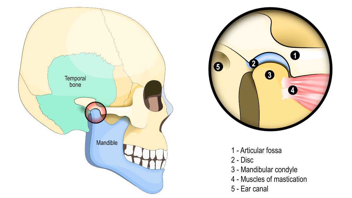 TMJ sutrikimo, kuris gali sukelti traškėjimą ausyje, iliustracija