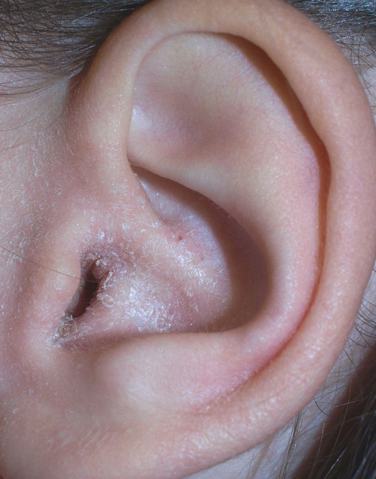 šupinaté ucho